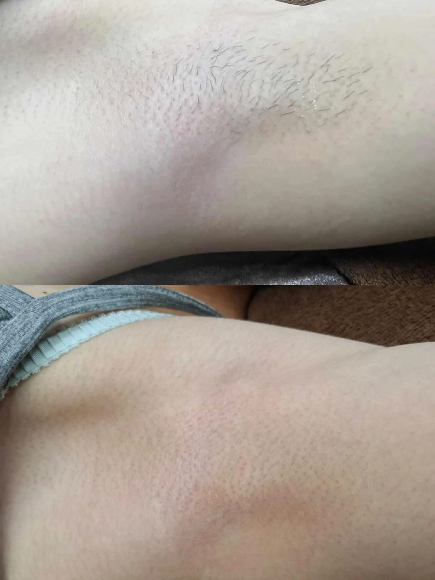 ジュニア脱毛👧👧🏻