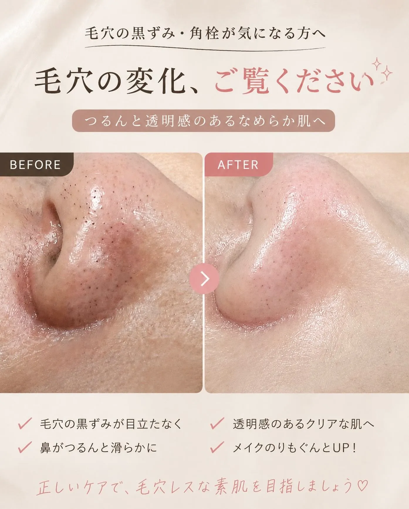 【毛穴の黒ずみ、諦めていませんか?】